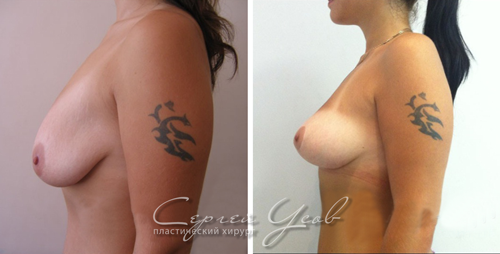 Операция - подтяжка груди. Фото до и после